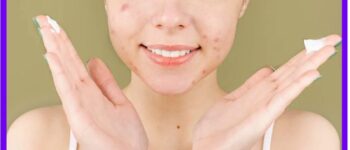 How to use toothpaste for acne safely