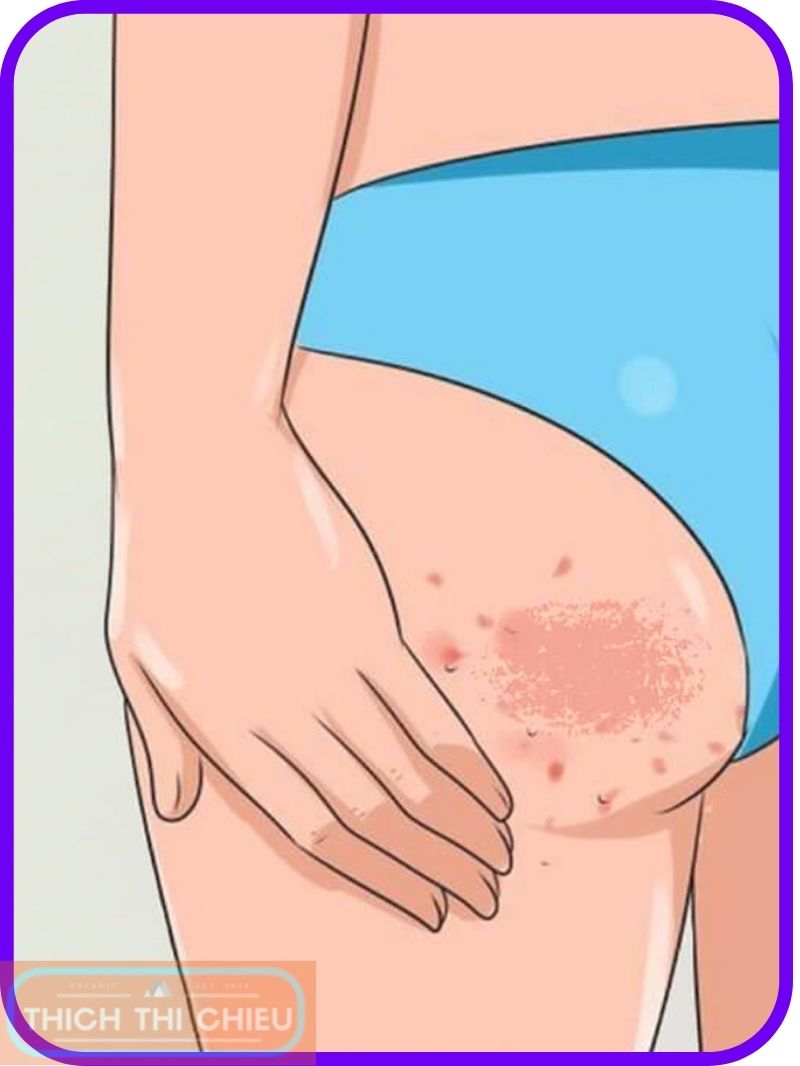 Causes of Dark Spots on Buttocks