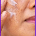 Melasma Prevention: Everything You Need to Know