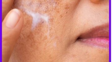 Melasma Prevention: Everything You Need to Know