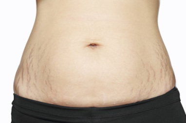 Stretch Marks in Teenagers Causes, Prevention, and Treatment