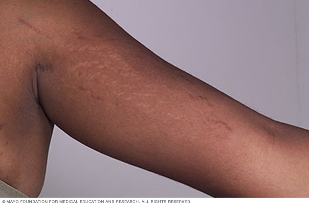 Stretch Marks in Teenagers Causes, Prevention, and Treatment